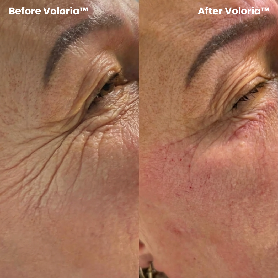 Voloria PDRN & Collagen Eye Patches