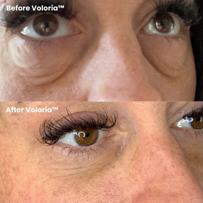 Voloria PDRN & Collagen Eye Patches