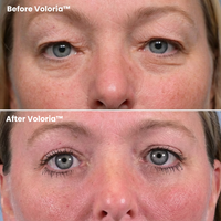 Voloria PDRN & Collagen Eye Patches